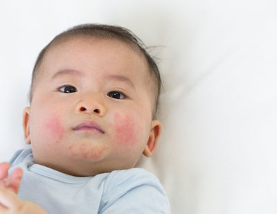 The Best Ways To Treat Your Baby’s Skin Rash